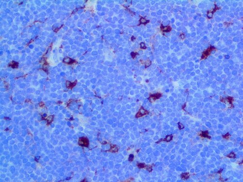 IHC of MMP-9 on an FFPE Lymphoblastic Lymphoma Tissue